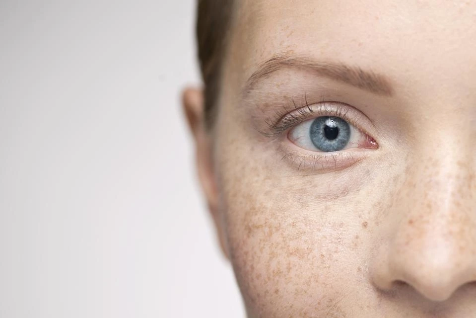 Understanding Sun Damage: How UV Rays Alter Skin and How CryoPen Can Reverse It Winchester