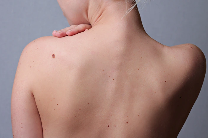 The Skin’s Healing Journey After CryoPen Sun Damage Treatment Winchester