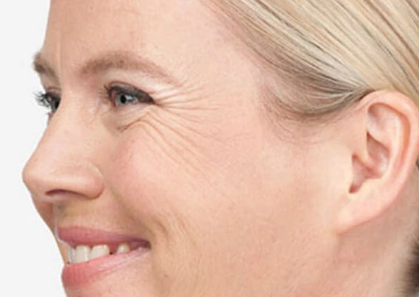 CryoPen Precision vs. Laser: Which Is Better for Sun-Damaged Skin? Winchester