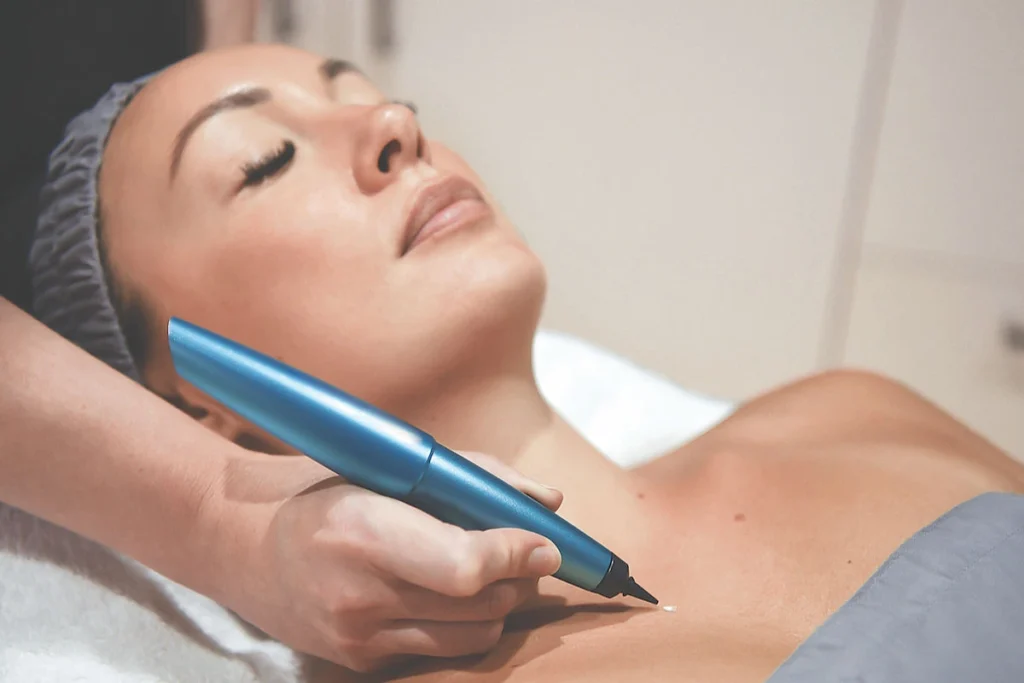 What is CryoPen Technology Winchester? Winchester