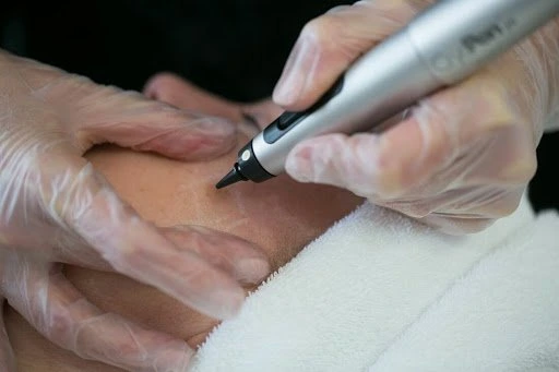 The CryoPen Technology Explained: How Extreme Cold Removes Sun-Damaged Skin Cells Winchester