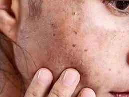 Why CryoPen Works Best for Isolated Sun Spots and Pigmentation Winchester