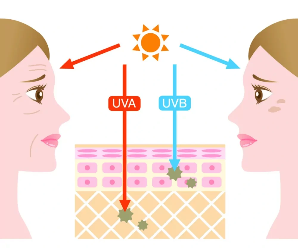 Understanding Sun Damage Winchester - Why Should Sun Damage Be Treated Early? Winchester